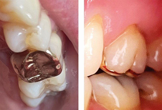 Root canal with high strength dental filling